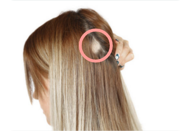 Alopecia areata