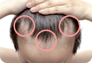 Androgener Haarausfall